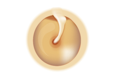 perforación de tímpano